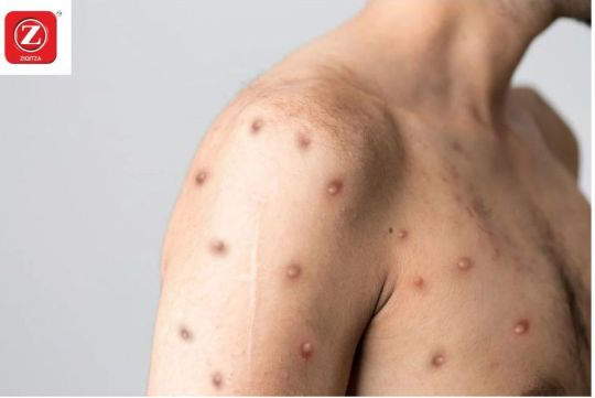 Monkeypox
